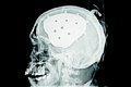 Cranio-Oss – X-ray image