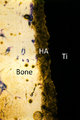 Osseointegration of hydroxyapatite-coated (HA) titanium (Ti) without interposed soft tissue 