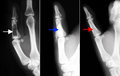 A defect caused by enchondroma (white arrow), filled with PORESORB-TCP (blue arrow), completely resorbed and with a completely regenerated bone structure after 12 months (red arrow).