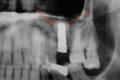 Internal sinus lift filled with PORESORB-TCP material, following implant insertion